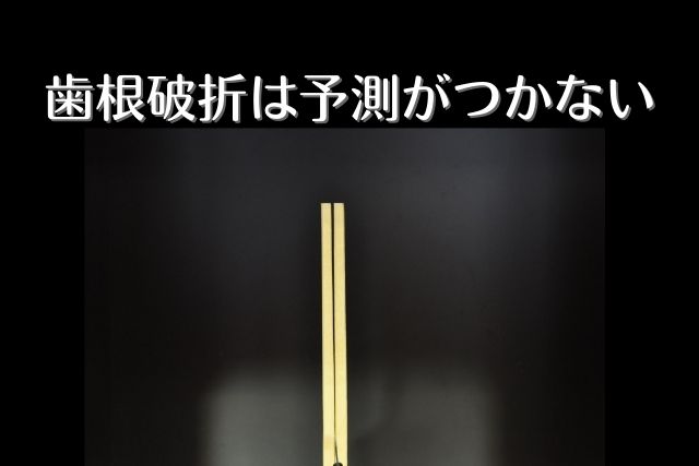 歯根破折で抜歯|いつ起こるかわからない歯の破折の予防|香川県の吉本歯科医院